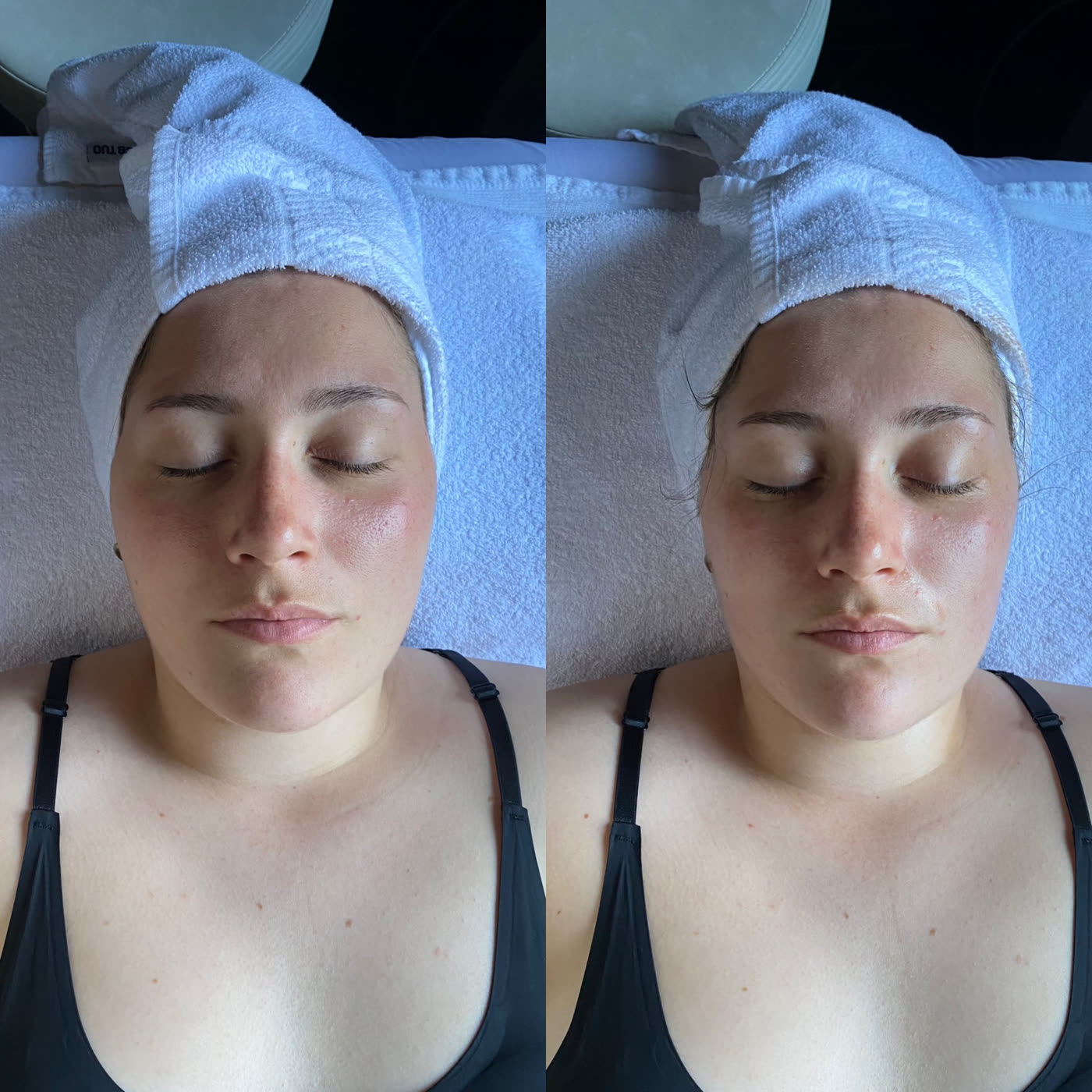 Avant / après un soin visage Lab Therapy : visage dégonflé, traits redessinés